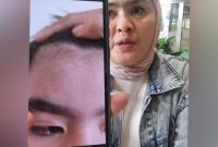 Orang tua korban dugaan perundungan di Alexandria Islamic School ketika menunjukkan luka di mata yang mengenai sarafnya dan beberapa anggota tubuh lainnya. (Dok. MEDIA INVESTIGASI)