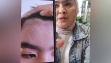 Orang tua korban dugaan perundungan di Alexandria Islamic School ketika menunjukkan luka di mata yang mengenai sarafnya dan beberapa anggota tubuh lainnya. (Dok. MEDIA INVESTIGASI)