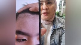 Orang tua korban dugaan perundungan di Alexandria Islamic School ketika menunjukkan luka di mata yang mengenai sarafnya dan beberapa anggota tubuh lainnya. (Dok. MEDIA INVESTIGASI)
